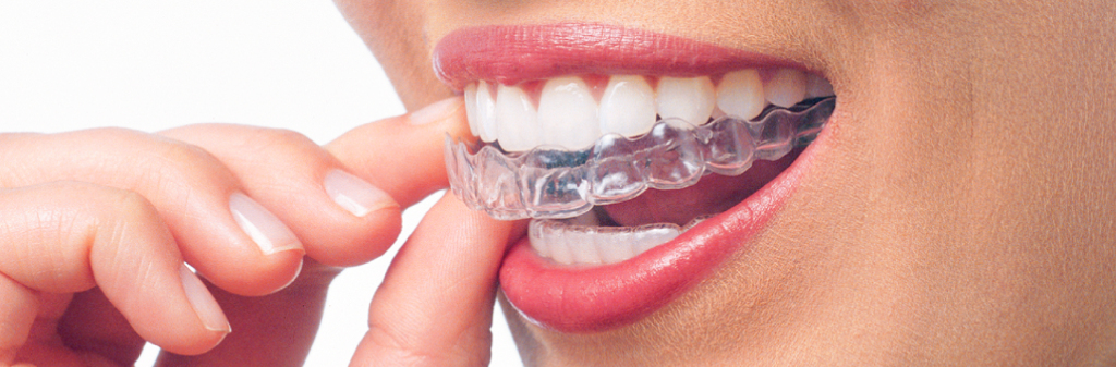 orthodontic-treatment-or-invisalign