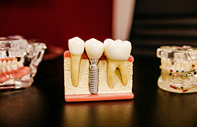 Dental Implants